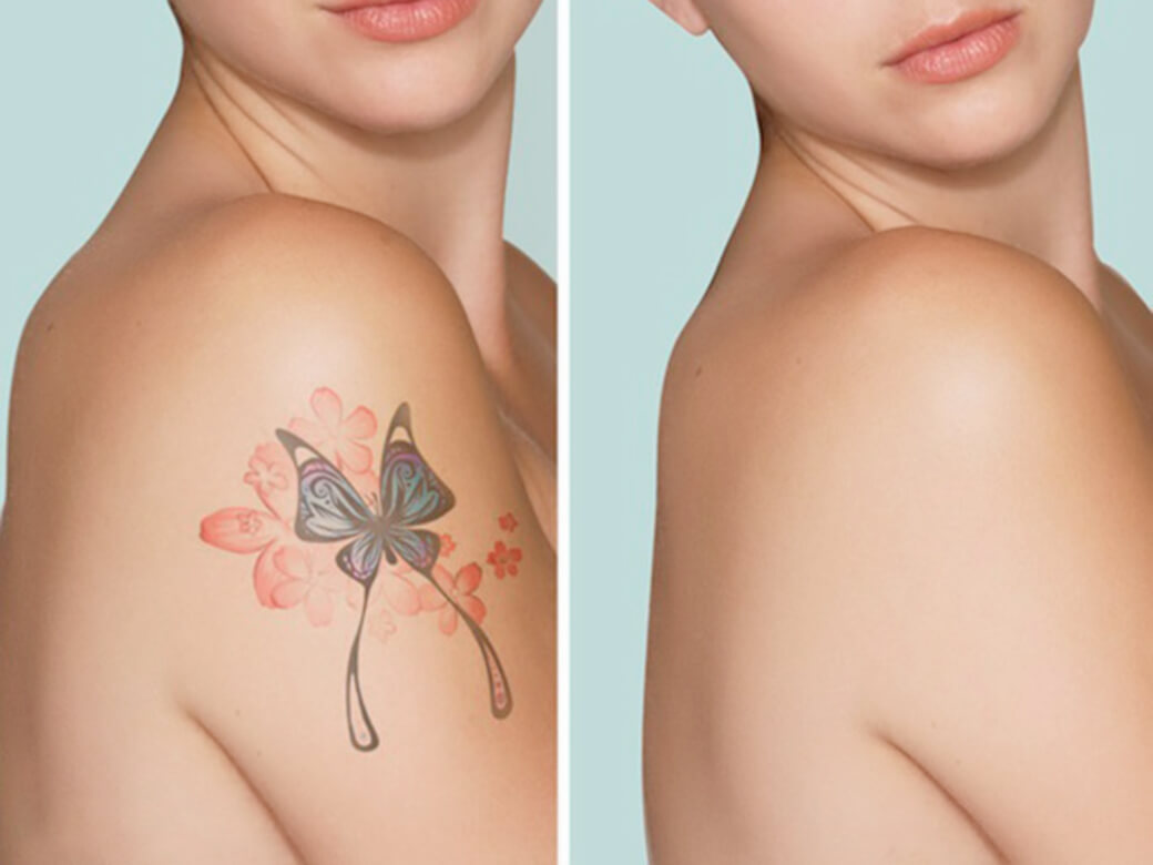 New Leaf Skin & Beauty Upper Hutt - Tattoo Removal