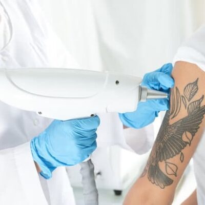 the-costs-of-tattoo-removal