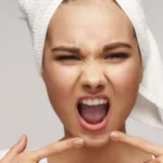 How To Avoid Pimples On Chin - skinoxy clinic