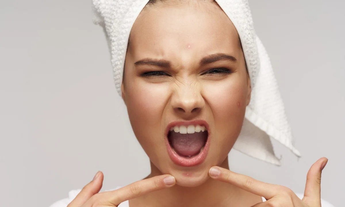 How To Avoid Pimples On Chin - skinoxy clinic