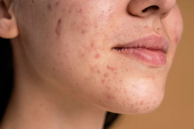 how to get rid of pimples overnight - skinoxy clinic